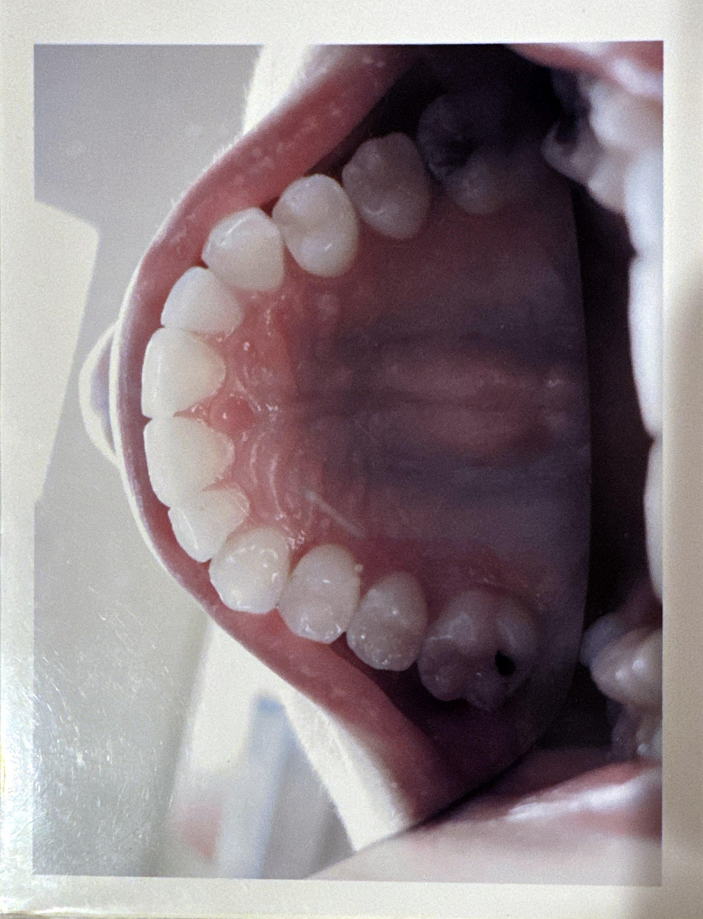 Teeth transformation after Invisalign